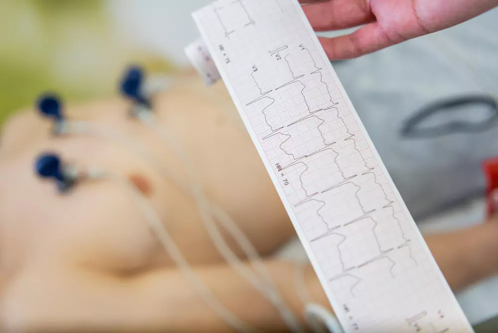 Electrocardiogram (ECG)
